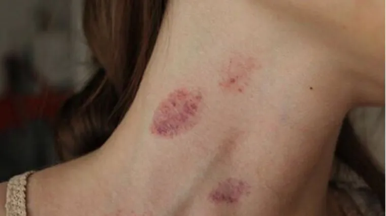 Modrica na vratu materijalni je dokaz da ste sinoć bili vatreni, ali ne samo to