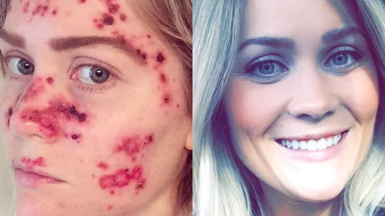 'Bolje biti blijed nego mrtav'