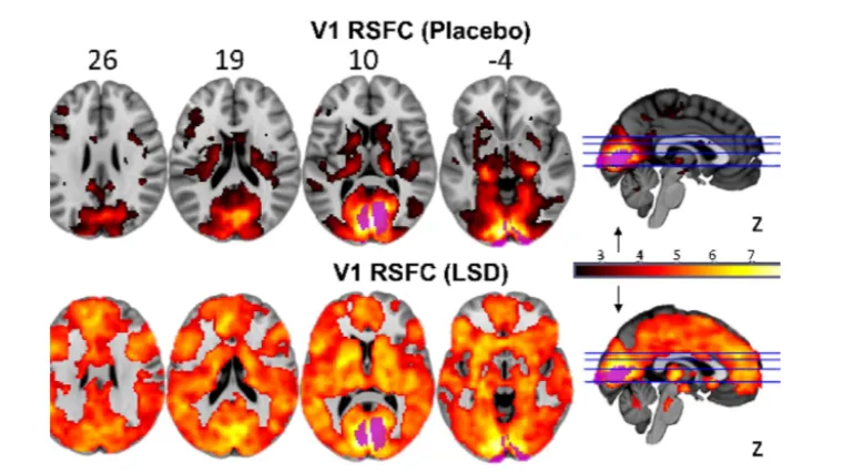 Istraživanje pokazalo kako ljudski mozak pod utjecajem LSD-a funkcionira bolje od 'običnog' mozga
