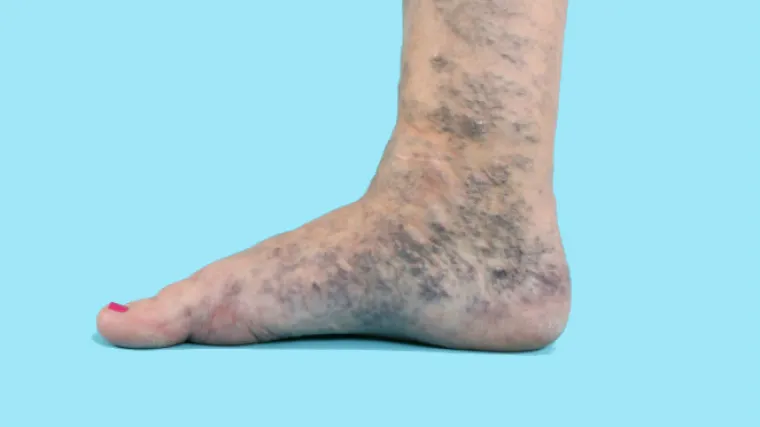 Rije&scaron;ite se ružnih pro&scaron;irenih vena zauvijek &ndash; BEZ bolnih operacija i opasnih lasera!