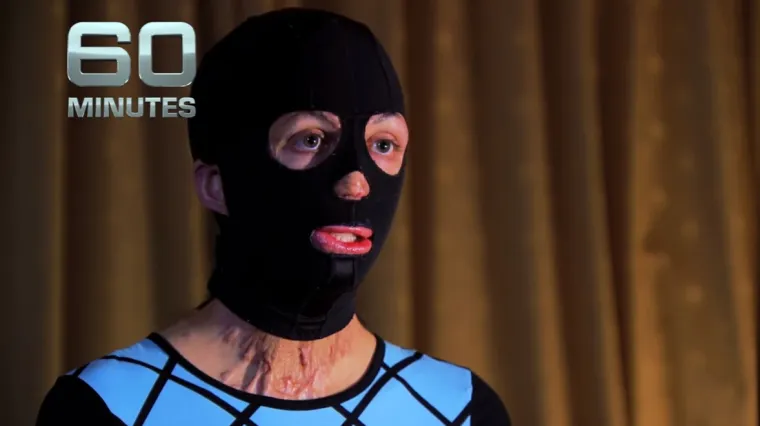 Priča o bivšoj manekenki kojoj je vatra unakazila lice još je jedan dokaz da prava ljubav pobjeđuje sve