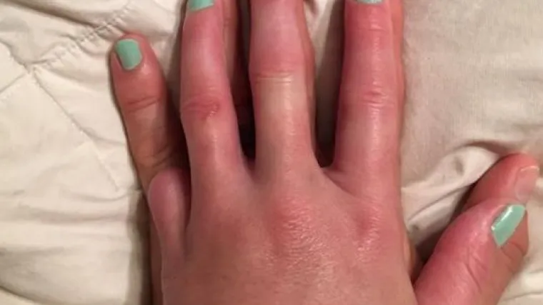 Prekrasna gesta: suprug nalakirao mali prst kako bi pružio podr&scaron;ku ženi koja je izgubila svoj