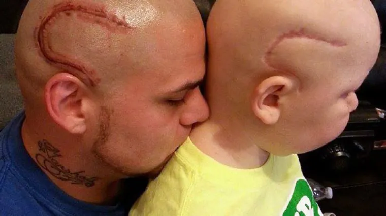 Otac istetovirao ožiljak kako bi bolesnom sinu ojačao samopouzdanje