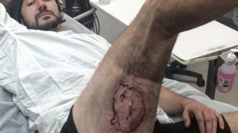 Biciklist pao na iPhone i zavr&scaron;io u bolnici s opeklinama trećeg stupnja: 'Zalijepio mi se za nogu, osjetio sam snažnu bol'