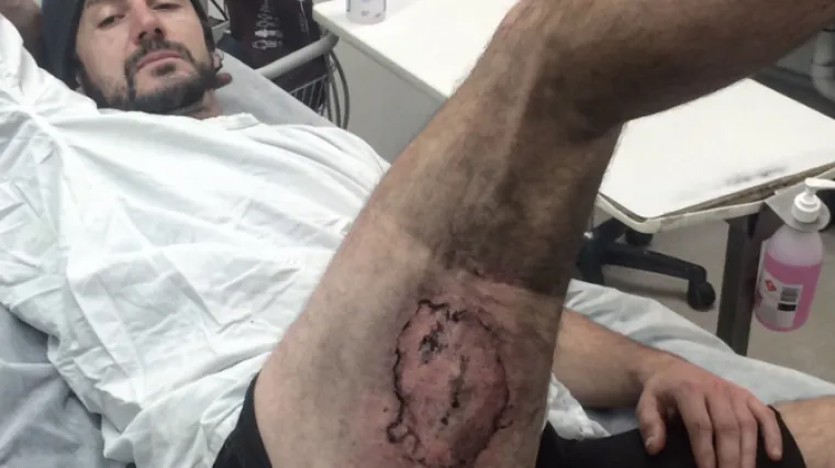 'Od eksplozije baterije iPhonea 6 zadobio sam opekline trećeg stupnja'