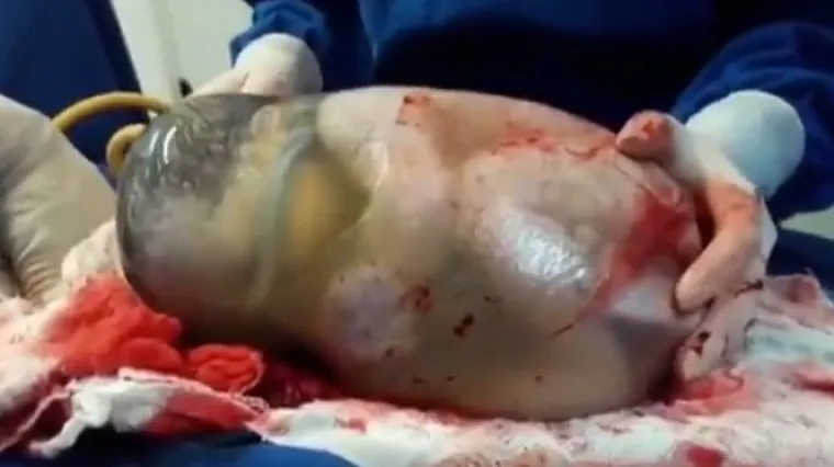 Maleno čudo u brazilskom rodilištu: novorođenče otkrilo  svijet nevidljiv našim očima