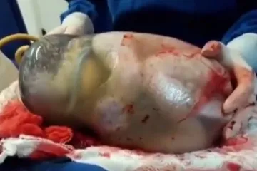 Maleno čudo u brazilskom rodilištu: novorođenče otkrilo  svijet nevidljiv našim očima