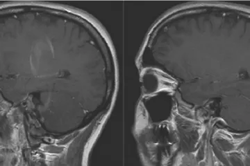 Zika razara i mozak odraslih osoba