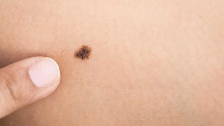 Nema vi&scaron;e melanoma? Izraelski znanstvenici otkrili kako zaustaviti &scaron;irenje raka kože