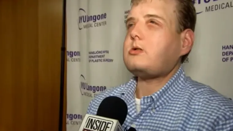 Vatrogasac kojem je prije godinu dana transplantirano lice osjeća se izvrsno