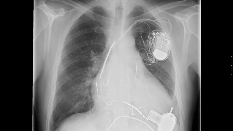 Izumili jestivu bateriju koja pokreće medicinske uređaje u tijelu