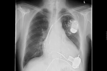 Izumili jestivu bateriju koja pokreće medicinske uređaje u tijelu
