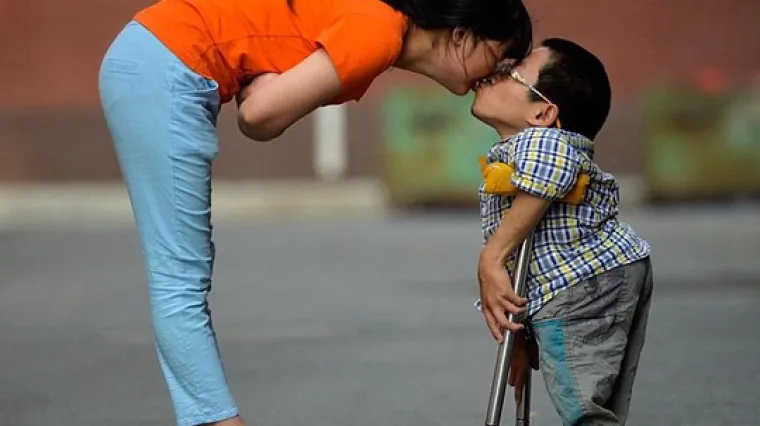 Mu&scaron;karac visine 76 centimetara i žena s brojnim ožiljcima žive u skladnom braku