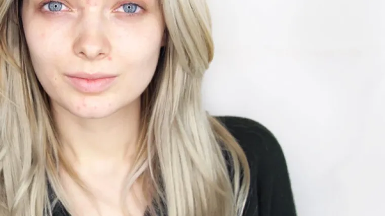 Osam mitova o aknama u koje ne biste trebali vjerovati