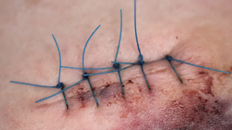 Otkazali mu dvije operacije, pa stvar uzeo u svoje ruke: sam izvadio konce iz trbuha