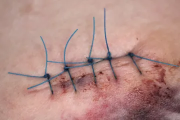 Otkazali mu dvije operacije, pa stvar uzeo u svoje ruke: sam izvadio konce iz trbuha