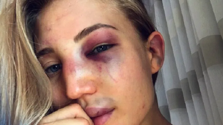 Jedna od najljep&scaron;ih sporta&scaron;ica svijeta &scaron;okirala fotografijom nakon borbe