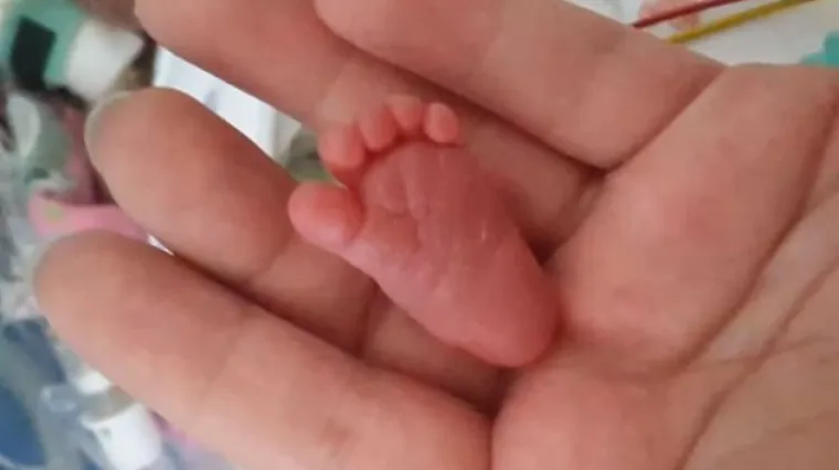 Upoznajte najmanju bebu na svijetu koja je uspjela preživjeti: veliki borac Emilija