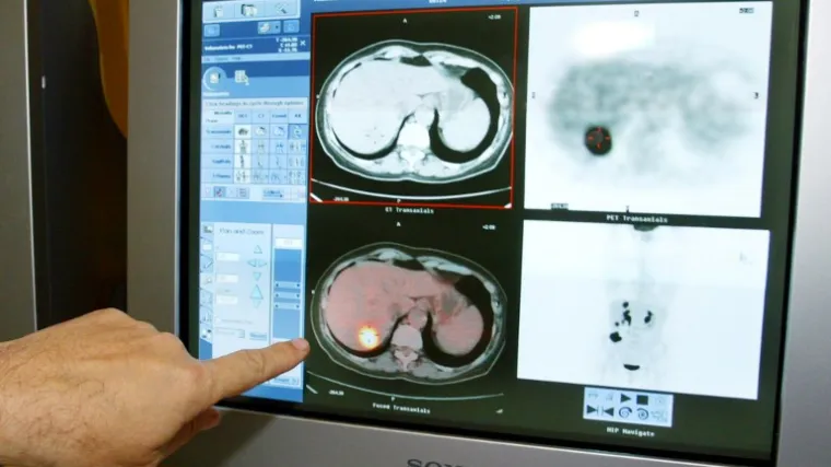 U Microsoftu tvrde da imaju rješenje za izlječenje raka!