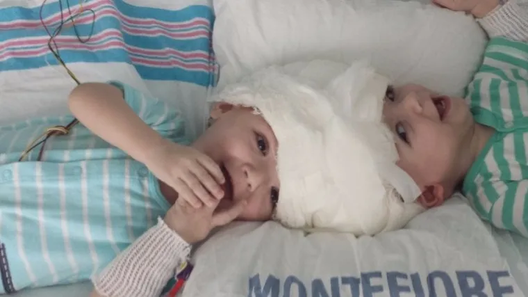 Kirurzi uspje&scaron;no operirali sijamske blizance spojenih glava: zahvat trajao 16 sati