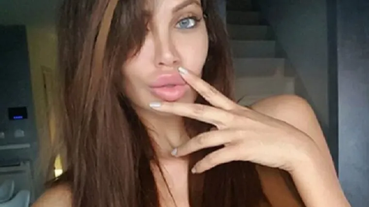 Soraja se hvali ekstenzijama, a napali je zbog golemih usnica