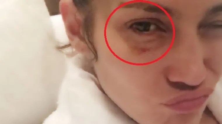 Objavljena fotografija J.Lo sa '&scaron;ljivom' na oku