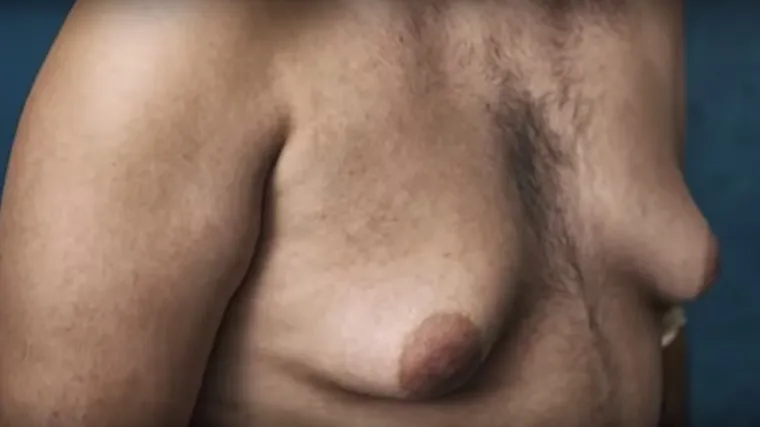 Pio lijek za psihičke poremećaje pa mu narasle ženske grudi