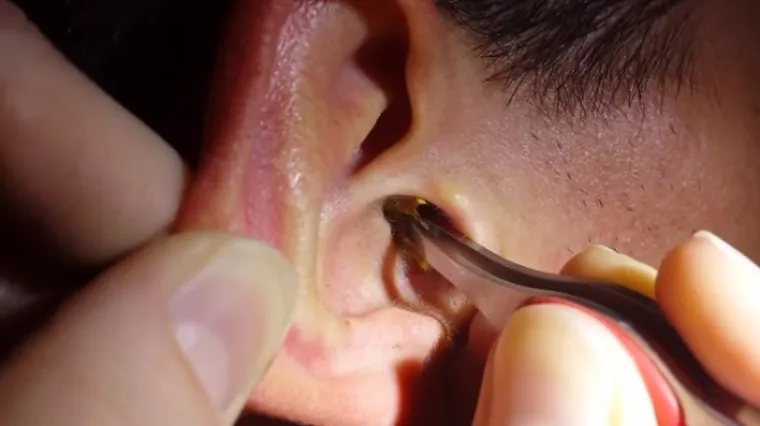 Tri načina da se napokon rije&scaron;ite dlaka u u&scaron;ima