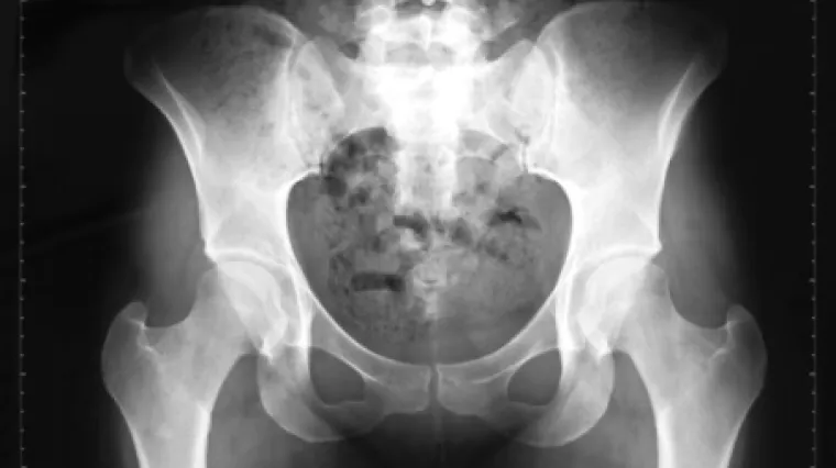 Majka u vagini poku&scaron;ala pro&scaron;vercati heroin sinu na robiji. Plan nije uspio