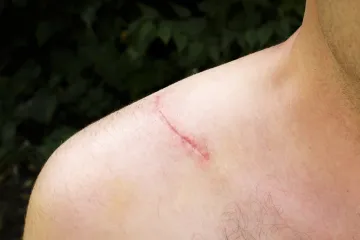 Otkriven način saniranja ozlijeda bez ožiljaka