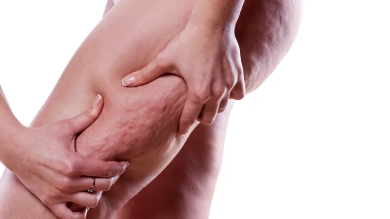 Željele biste se rije&scaron;iti celulita? Ovo je jedino pravo rje&scaron;enje, ni&scaron;ta drugo ne pali