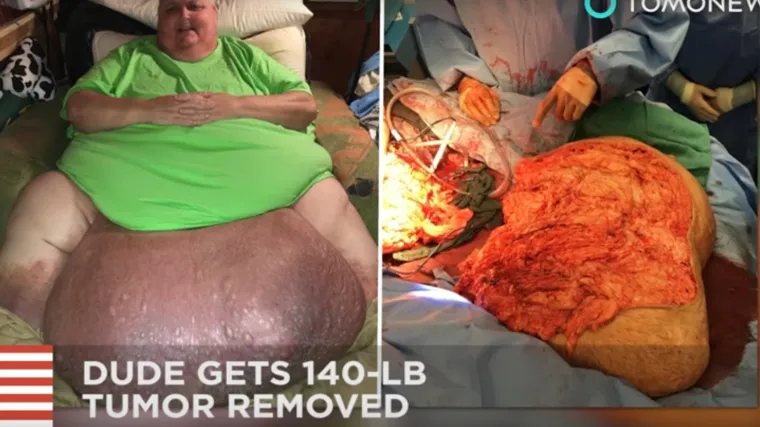 Ovom čovjeku uklonili su tumor od 59 kilograma!