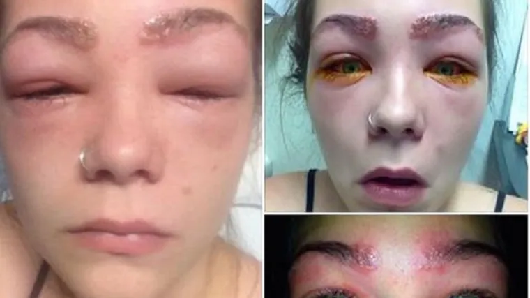 Tinejdžerica na Faceu objavila upozorenje sa stravičnim fotografijama