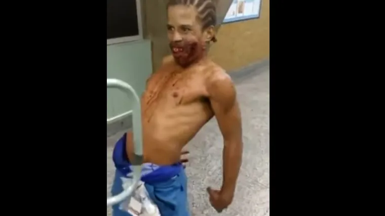 Čovjek s jezivim ozljedama tumara bolničkim hodnikom, izgleda kao opsjednut vragom