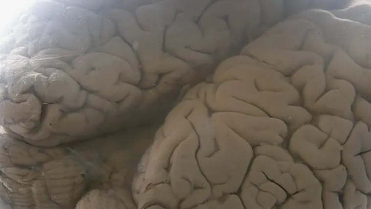 Tjedan mozga: Hrvatska po broju moždanih udara debelo iznad europskog prosjeka