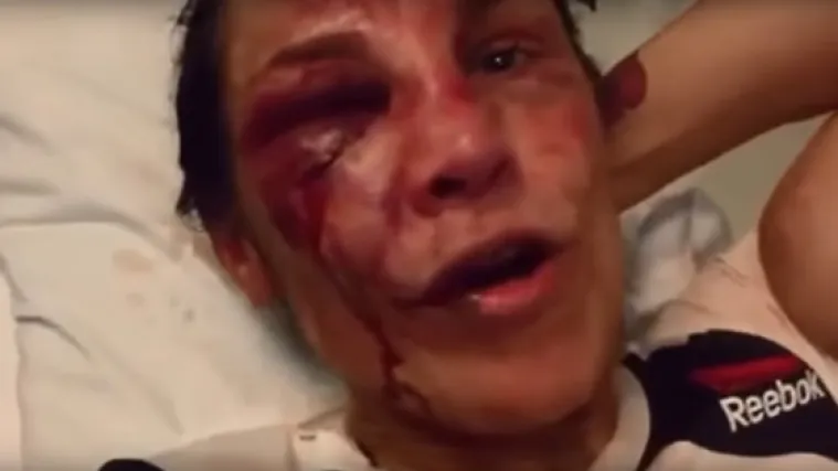 Pobjednica brutalne borbe gladijatorki zadobila stravične ozljede lica