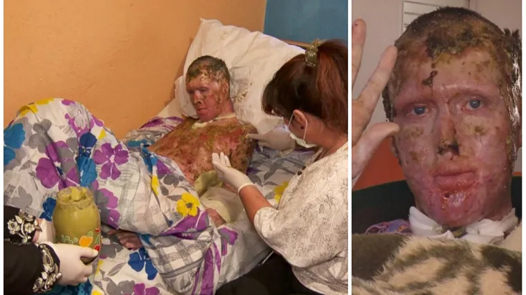 Cijela BIH pomogla mladiću kojeg je nećak polio benzinom i zapalio