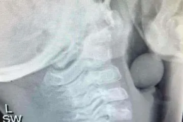 Ovaj rendgen moraju vidjeti svi roditelji, prije no što bude kasno