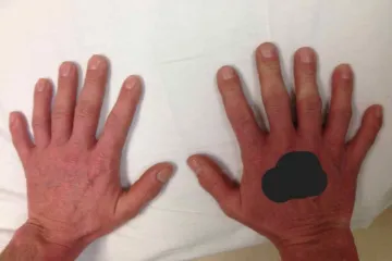 Liječnik objavio fotografiju kako bi pokazao da poremećaj nije rijedak kao &scaron;to se misli