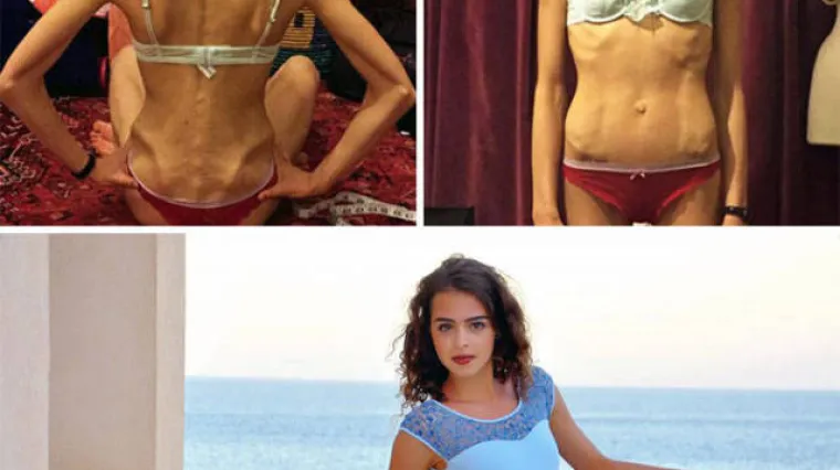 SABLASNE POSLJEDICE ANOREKSIJE: Objavili fotografije snimljene prije i nakon oporavka, rezultati su stvarno impresivni