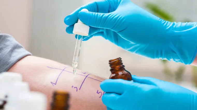 Testiranje na alergije: brz i siguran način da otkrijete na &scaron;to ste alergični