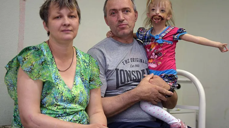 Obitelj se odrekla ove djevojčice, a mje&scaron;tani je nazivaju čudovi&scaron;tem samo zato jer je rođena bez usana i brade