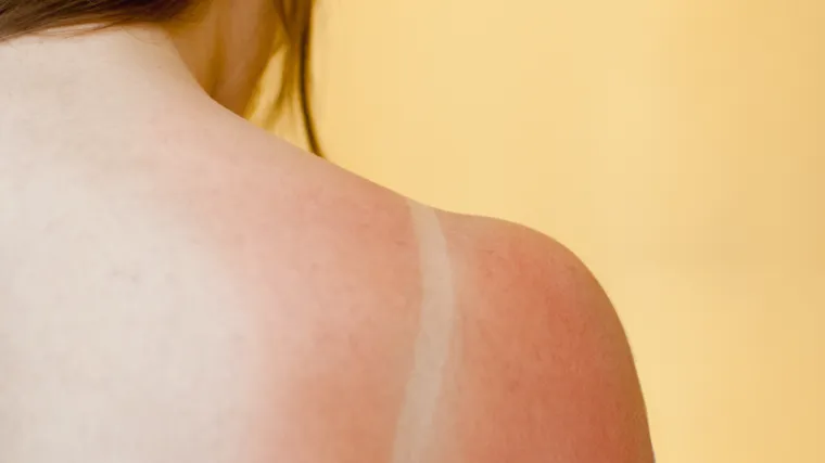 Opekline od sunca: kako ih ublažiti na prirodan način