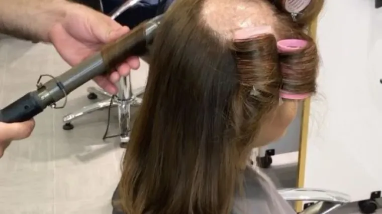 Odu&scaron;evit će vas transformacija kose ove žene: Do&scaron;la je u salon sa ćelavim dijelom na vrhu glave, a onda se dogodilo ovo