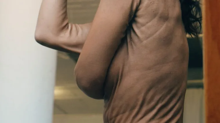 Djevojka s rijetkim genetskim poremećajem izaziva standarde ljepote - i uspijeva u tome