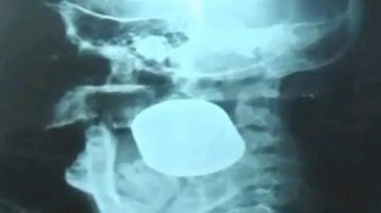 Nigerijac u probavnom traktu sakrio 79.000 eura