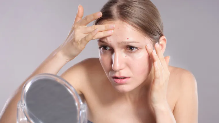 Evo što znači njihova pojava na određenim zonama lica