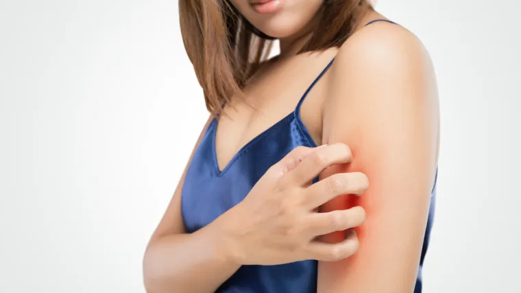 Nakon uboda komarca, če&scaron;anje samo pogor&scaron;ava stvar - probajte s kućnim melemima