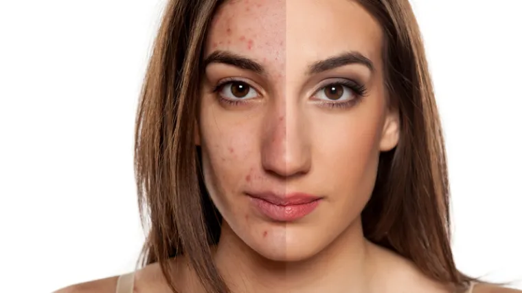 Je li sumpor magični lijek za akne? Dermatologinja i stručnjakinja za kožu otkrila je za&scaron;to je ovaj element učinkovit