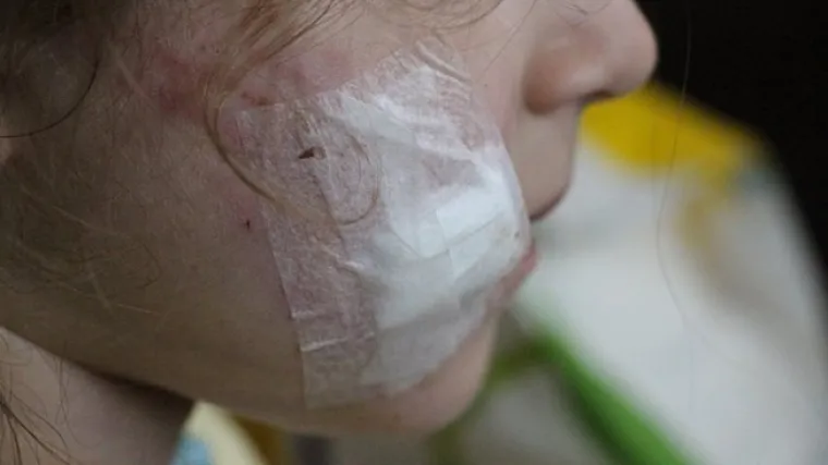 Desetogodi&scaron;nju djevojčicu napao pobje&scaron;njeli pas: 'Sru&scaron;io ju je na pod, ugrizao za lice i počeo čupati ruku'